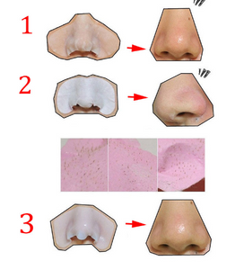 Remove Blackhead Kits